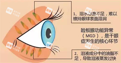瞼板腺疏通作用