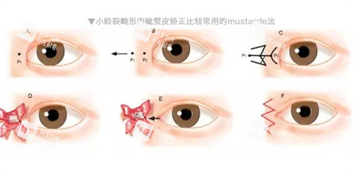 小瞼裂手術(shù)過程