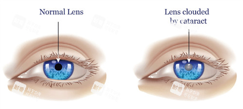 正常眼睛和白內(nèi)障眼睛的區(qū)別