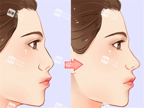 隆鼻手術前后對比展示 隆鼻手術前后對比展示