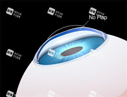 smart激光近視手術(shù)示意圖