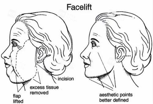 面部提升改善皮膚下垂等問題 面部提升改善皮膚下垂等問題