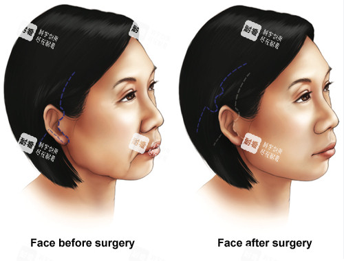 面部提升手術前后對比圖 面部提升手術前后對比圖