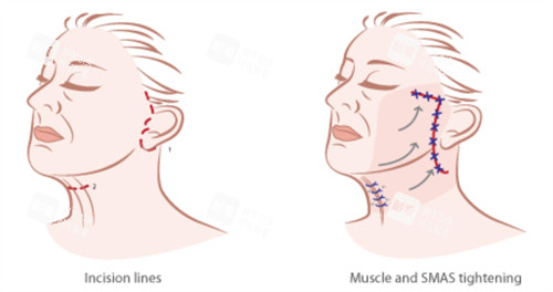 面部提升手術的對比和切口 面部提升手術的對比和切口