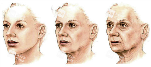 面部提升的皮膚前后對比 面部提升的皮膚前后對比