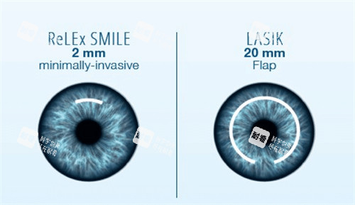 成都高新英華眼科近視手術價格：TICL定制晶體3萬起，半飛秒地形圖引導價格表