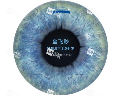 半飛秒手術(shù)卡通圖