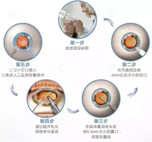 白內(nèi)障超聲乳化手術(shù)過程圖 白內(nèi)障超聲乳化手術(shù)過程圖