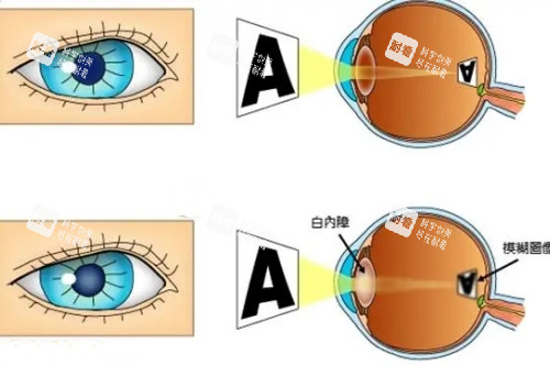 白內(nèi)障和正常眼睛卡通對(duì)比圖 白內(nèi)障和正常眼睛卡通對(duì)比圖