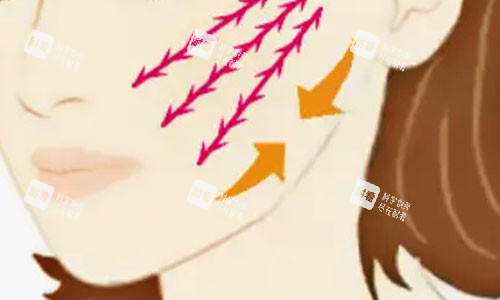 拉皮手術(shù)的大致流程示意圖