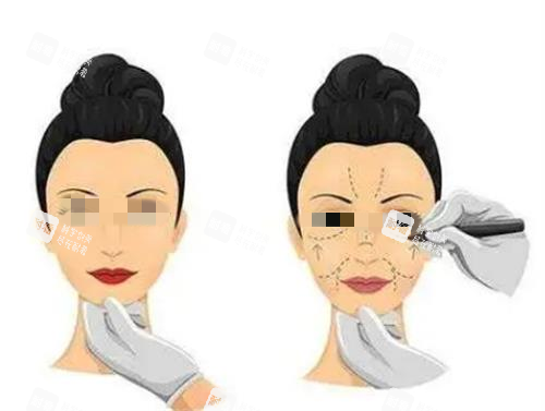 拉皮手術(shù)術(shù)前畫線圖